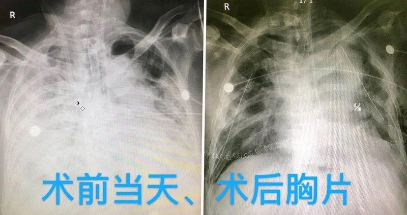 术后胸片（右肺移植 左上叶移植）.jpg