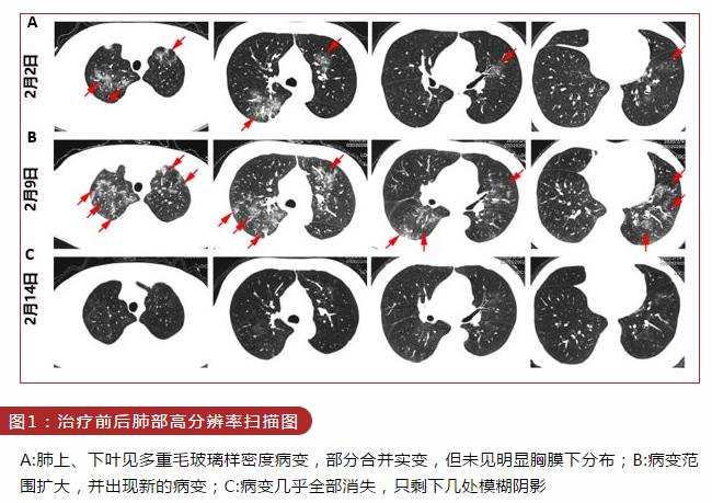 图1 治疗前后肺部高分辨率扫描图.jpg