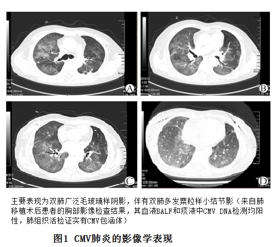 图1 cmv肺炎的影像学表现.png