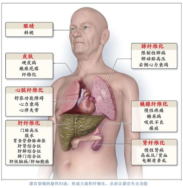 器官衰竭的最终归途：形成大面积纤维化，从而让器官失去功能.jpg