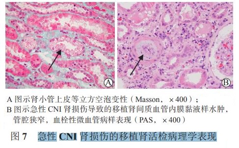 图7 急性CNI肾损伤的移植肾活检病理学表现.jpg