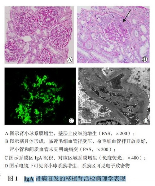图1 IgA肾病复发的移植肾活检病理学表现.jpg