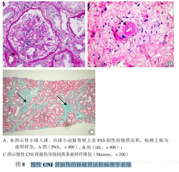 图8 慢性CNI肾损伤的移植肾活检病理学表现.jpg