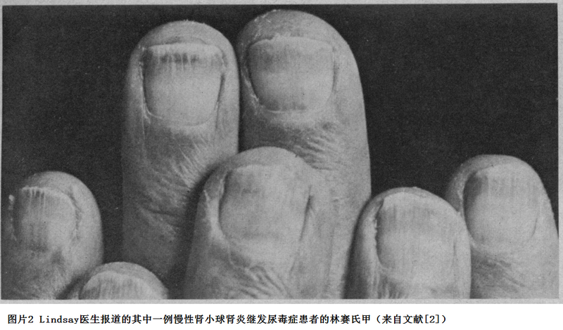 图片2 Lindsay医生报道的其中一例慢性肾小球肾炎继发尿毒症患者的林赛氏甲（来自文献[2]）.png