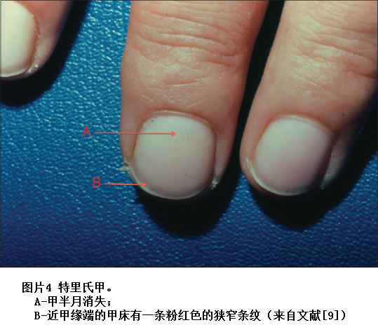 图片4 特里氏甲。A-甲半月消失，B-近甲缘端的甲床有一条粉红色的狭窄条纹（来自文献[9]）.png