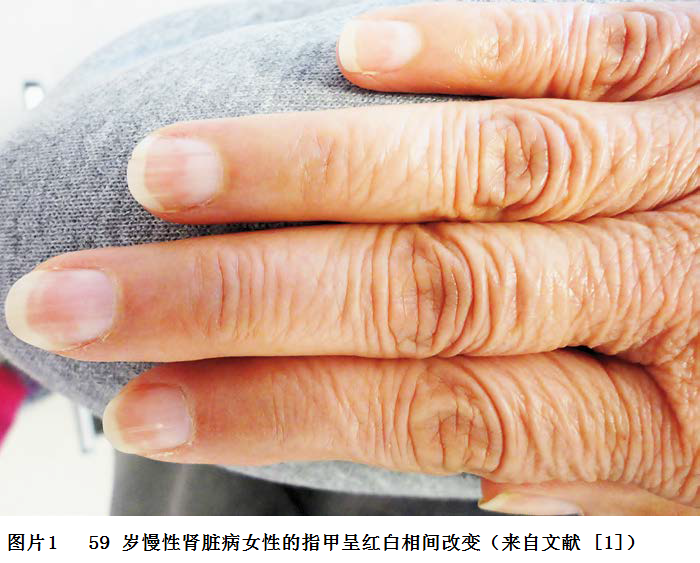 图片1 59岁慢性肾脏病女性的指甲呈红白相间改变.png