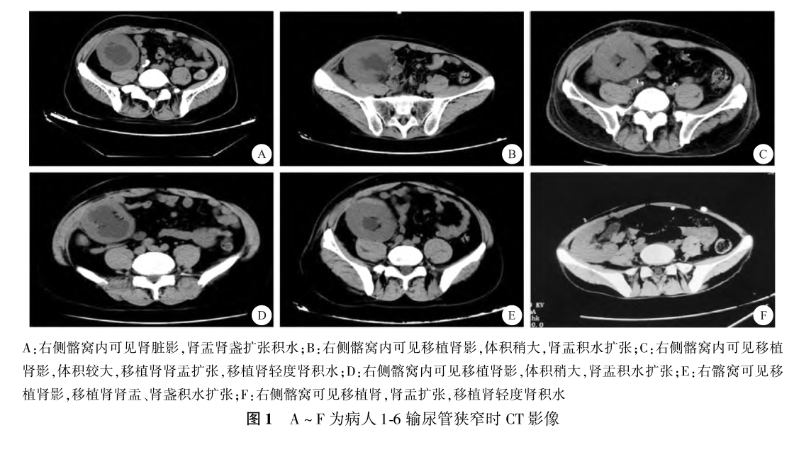 图1 a～f为病人1-6输尿管狭窄时ct影像.png